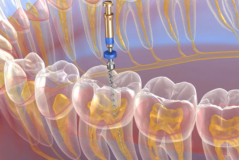 Root Canal Alternatives: Vital Pulp Therapy And Regenerative Endodontics 1 Bloom Holistic Dental: Dentist In New Jersey Rct Bloom Holistic Dental: Dentist In New Jersey